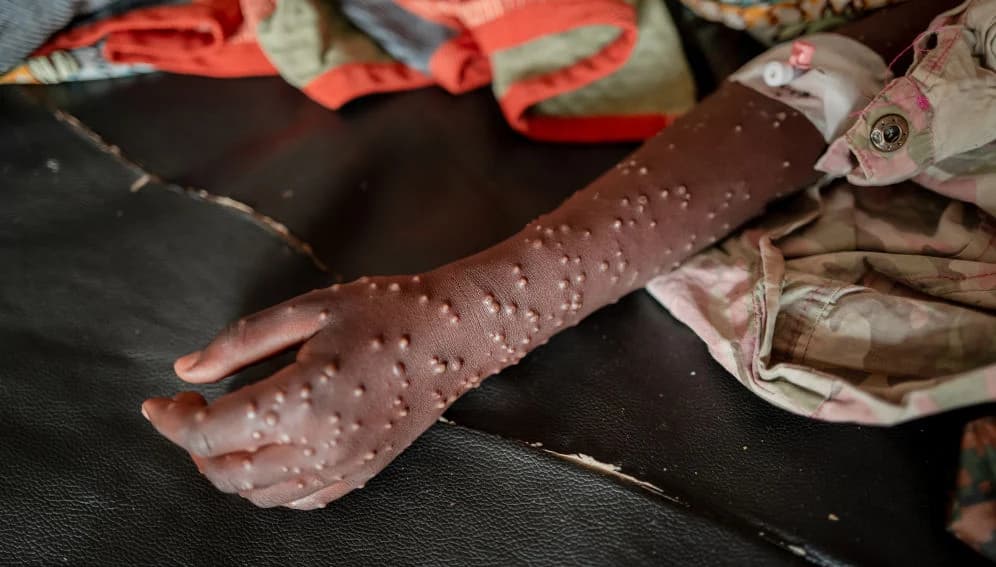 Just Ride actus / Un premier cas de Mpox nconfirmé à Antananarivo : la vigilance reste de mise